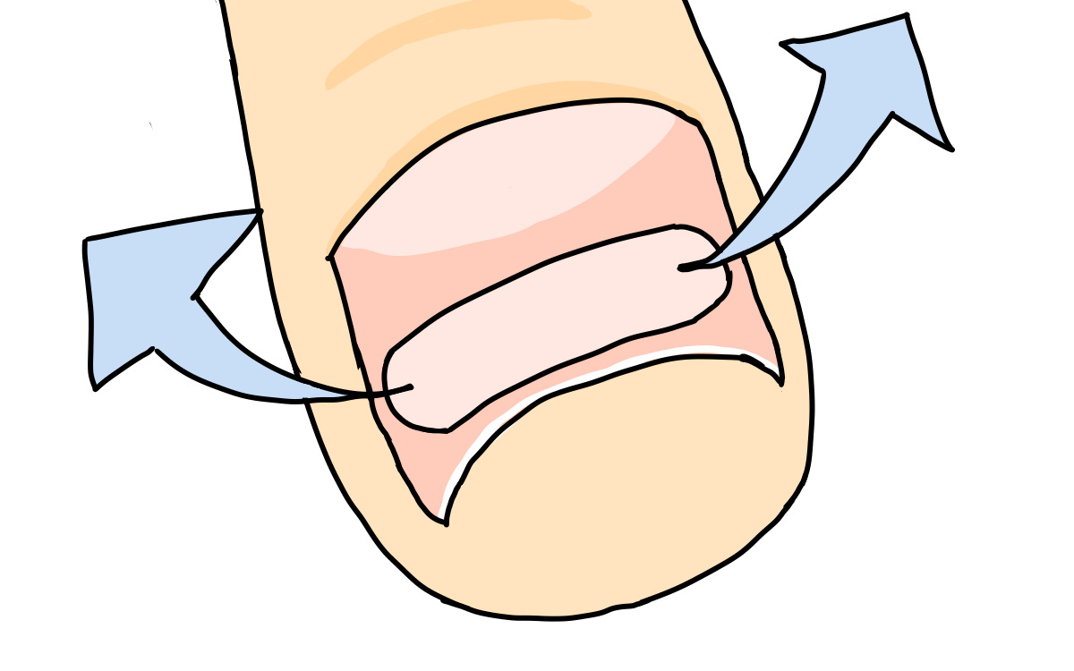 江ノ島　巻き爪　プレート矯正