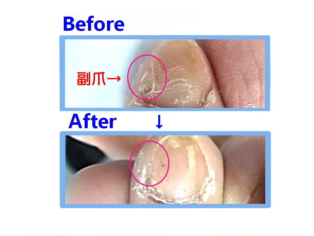 八王子市　巻き爪　副爪