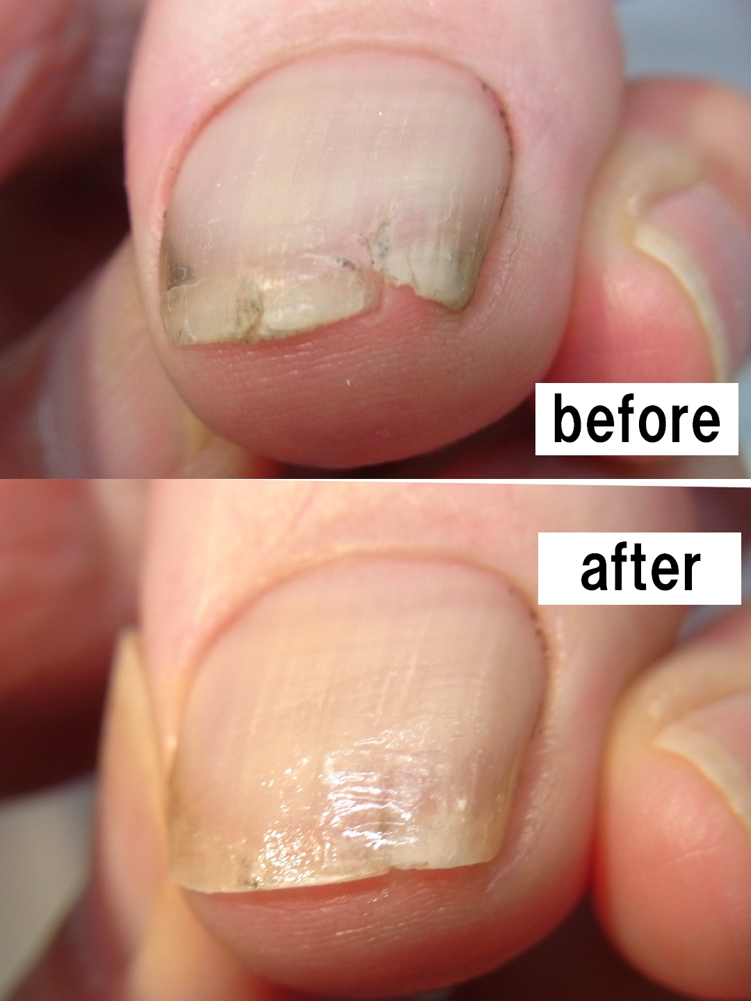 八王子市 巻き爪 割れ爪