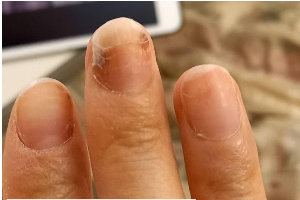 八王子市　巻き爪　爪