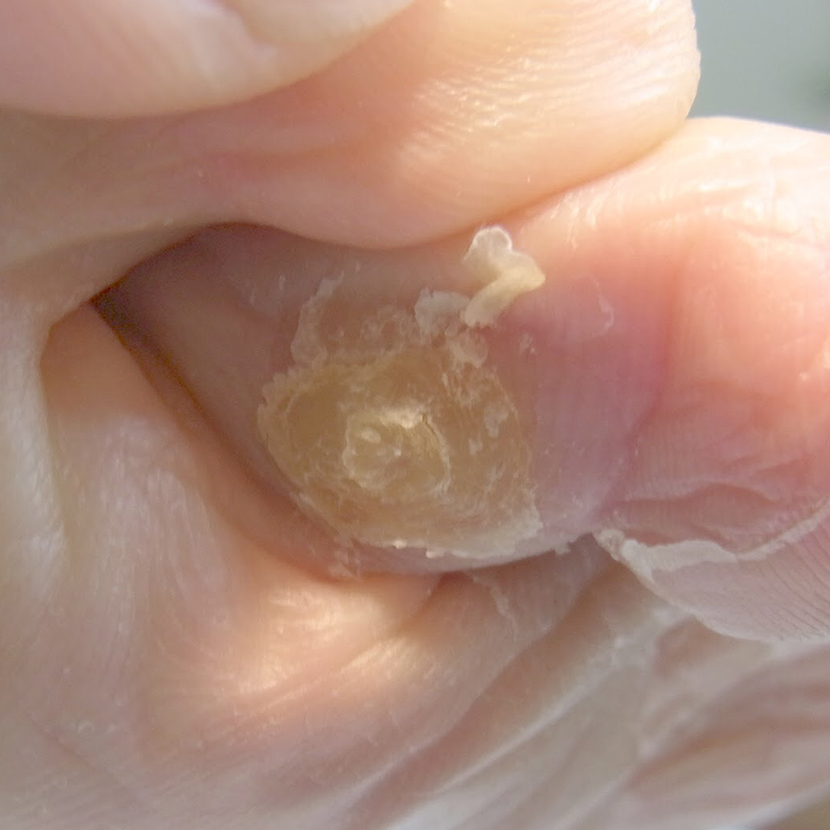 秦野市　巻き爪　魚の目