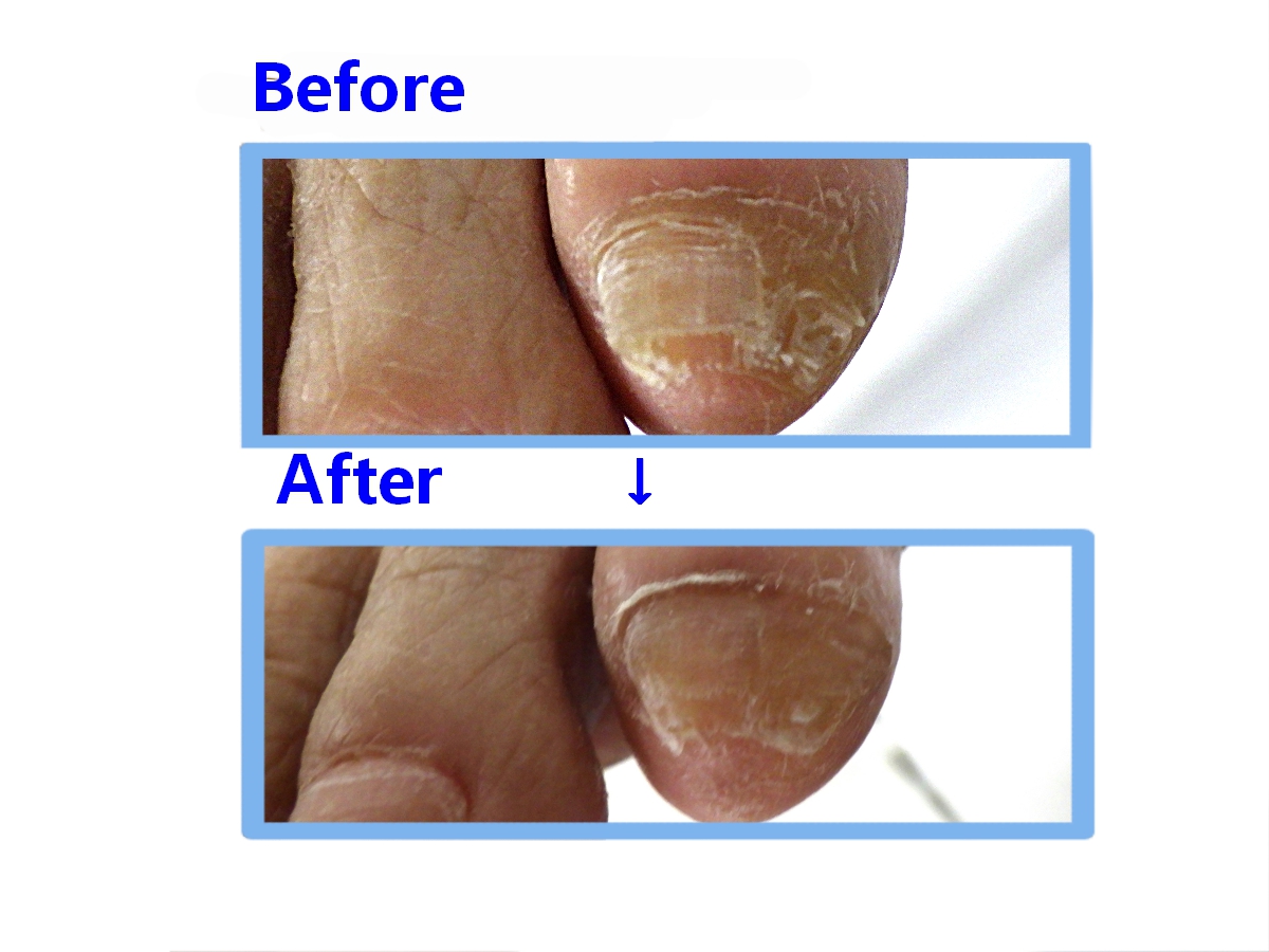 八王子市　巻き爪　副爪