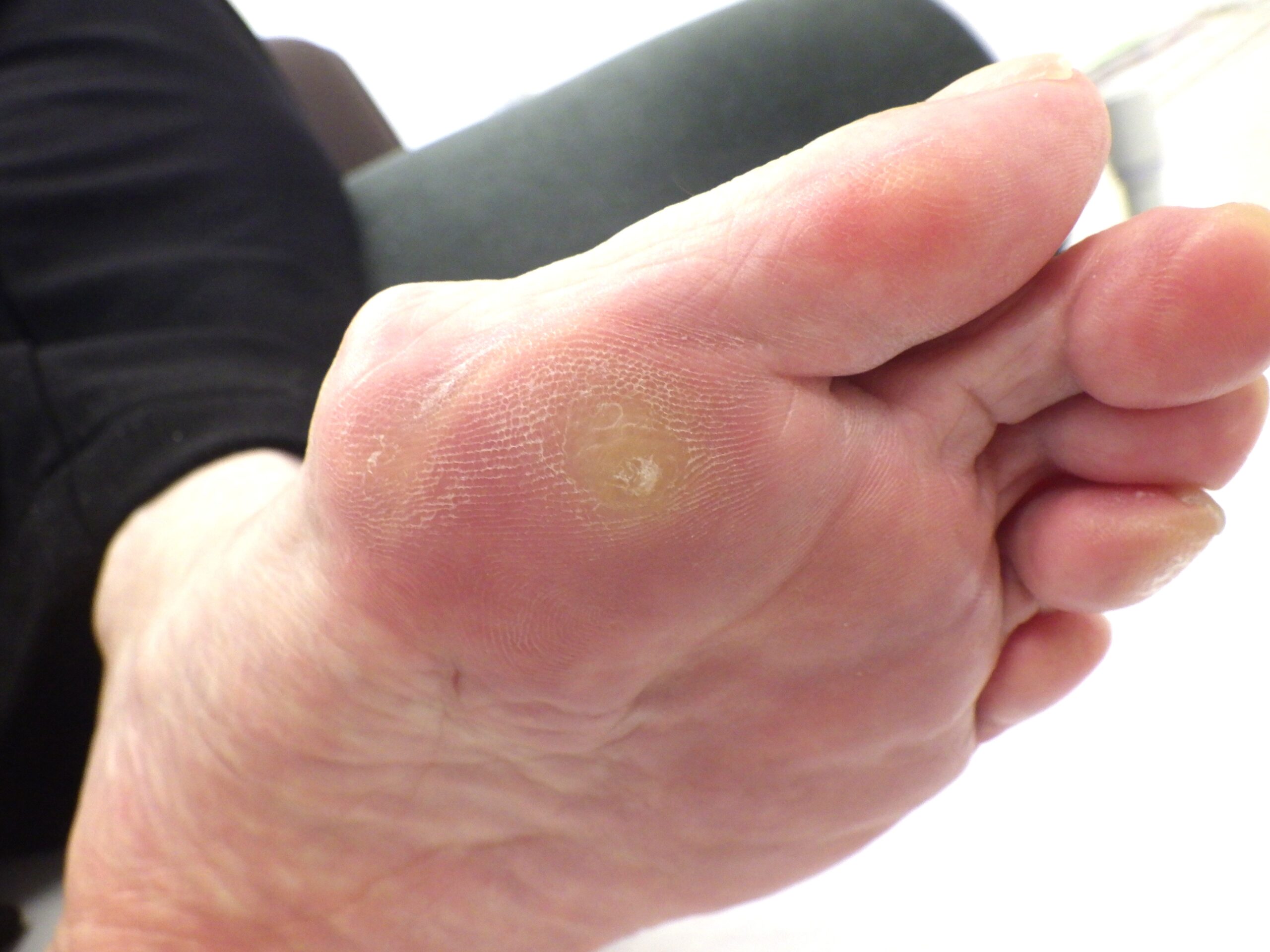 八王子市　巻き爪　ビフォー