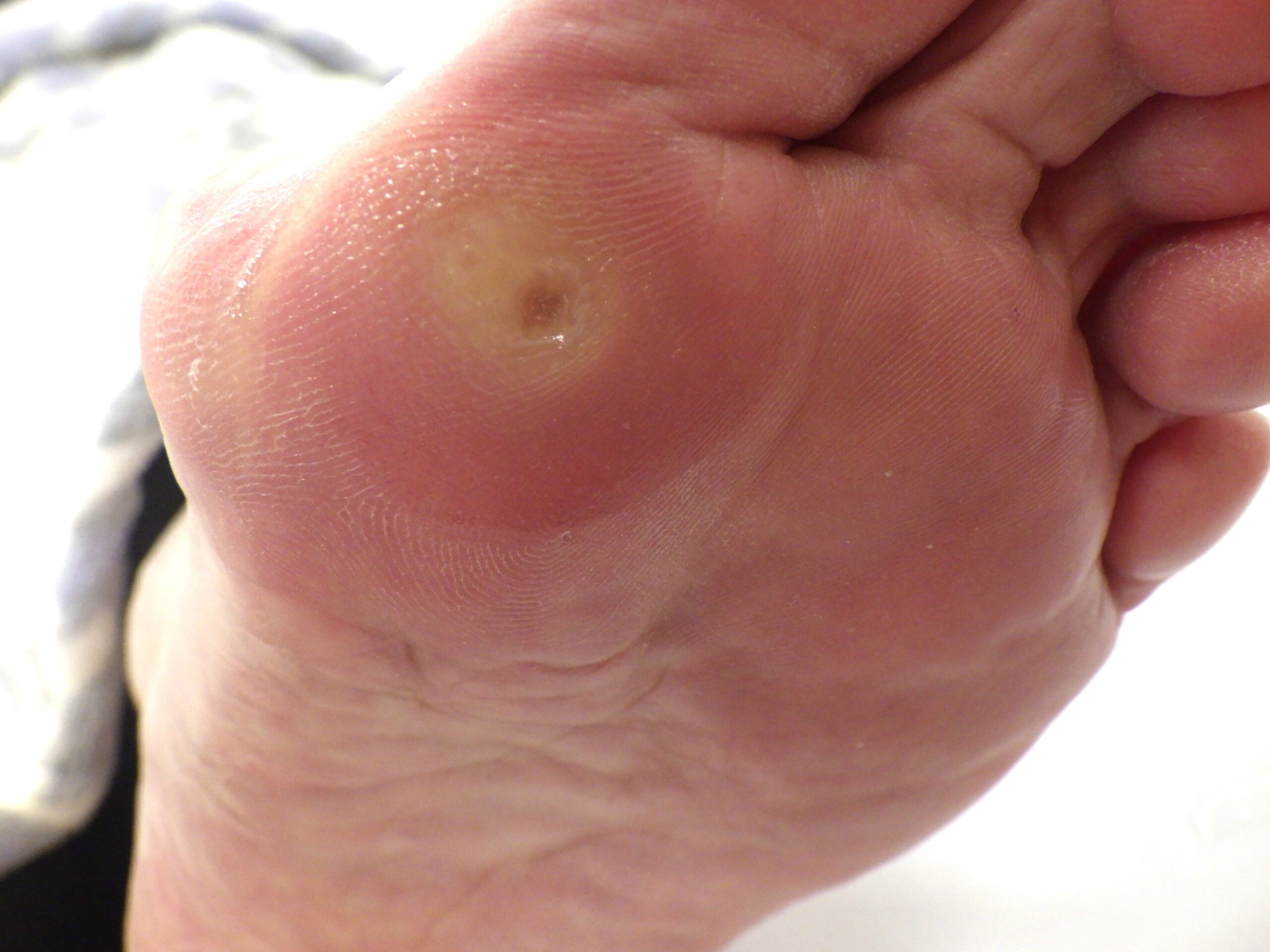 八王子市　巻き爪　アフター