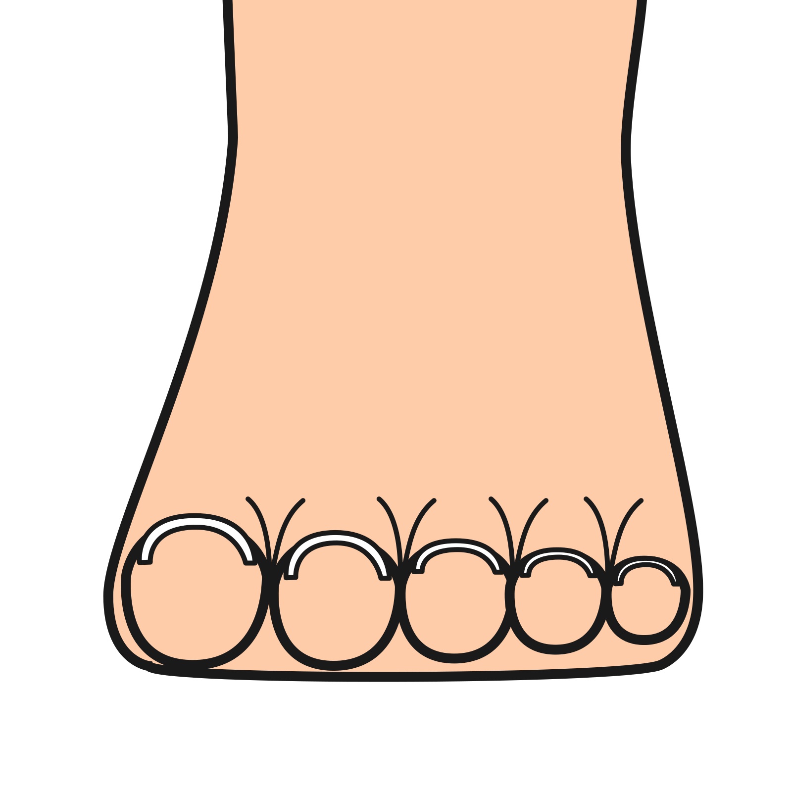 八王子市　巻き爪　開張足