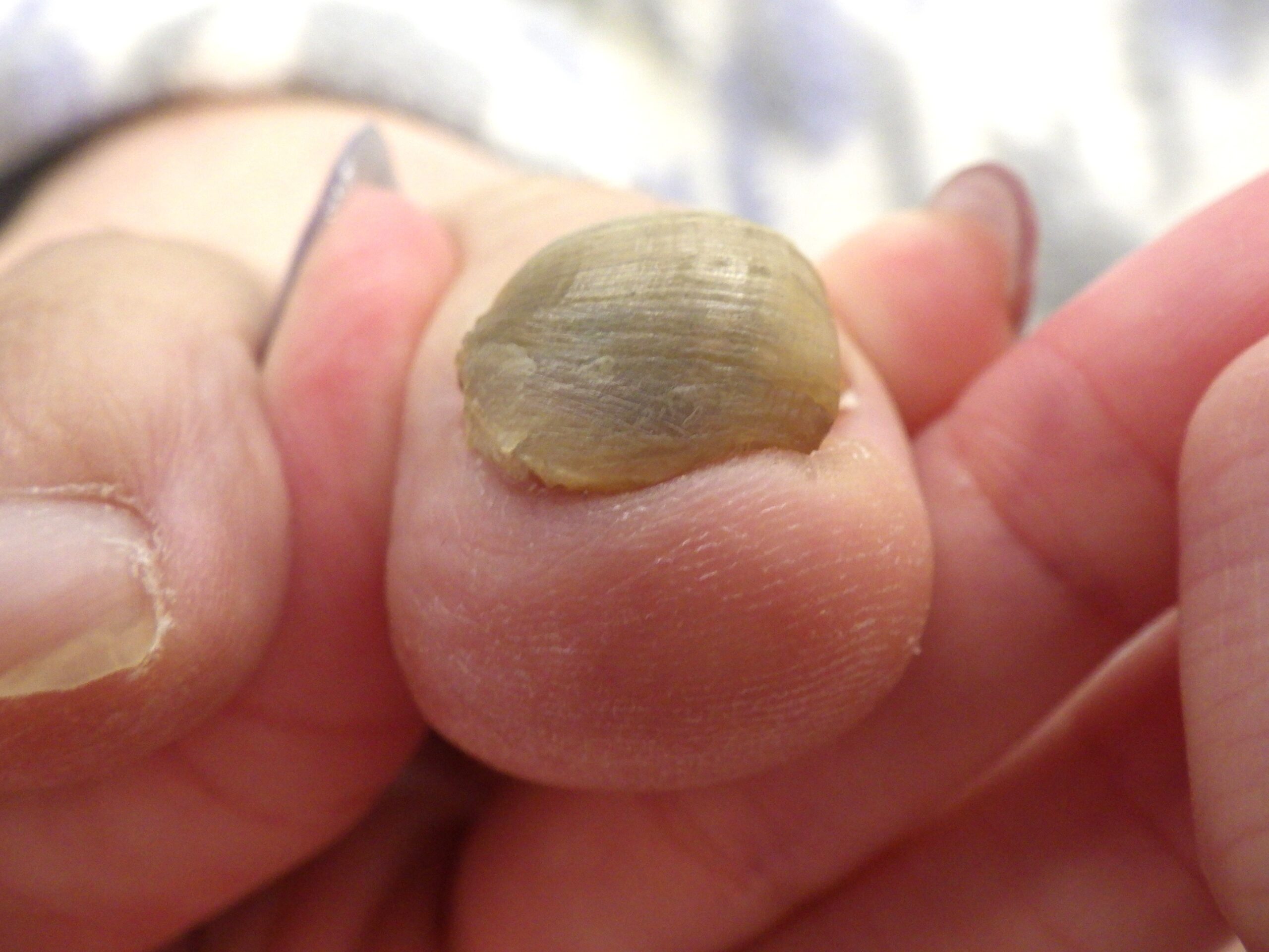 八王子市　巻き爪　ビフォー