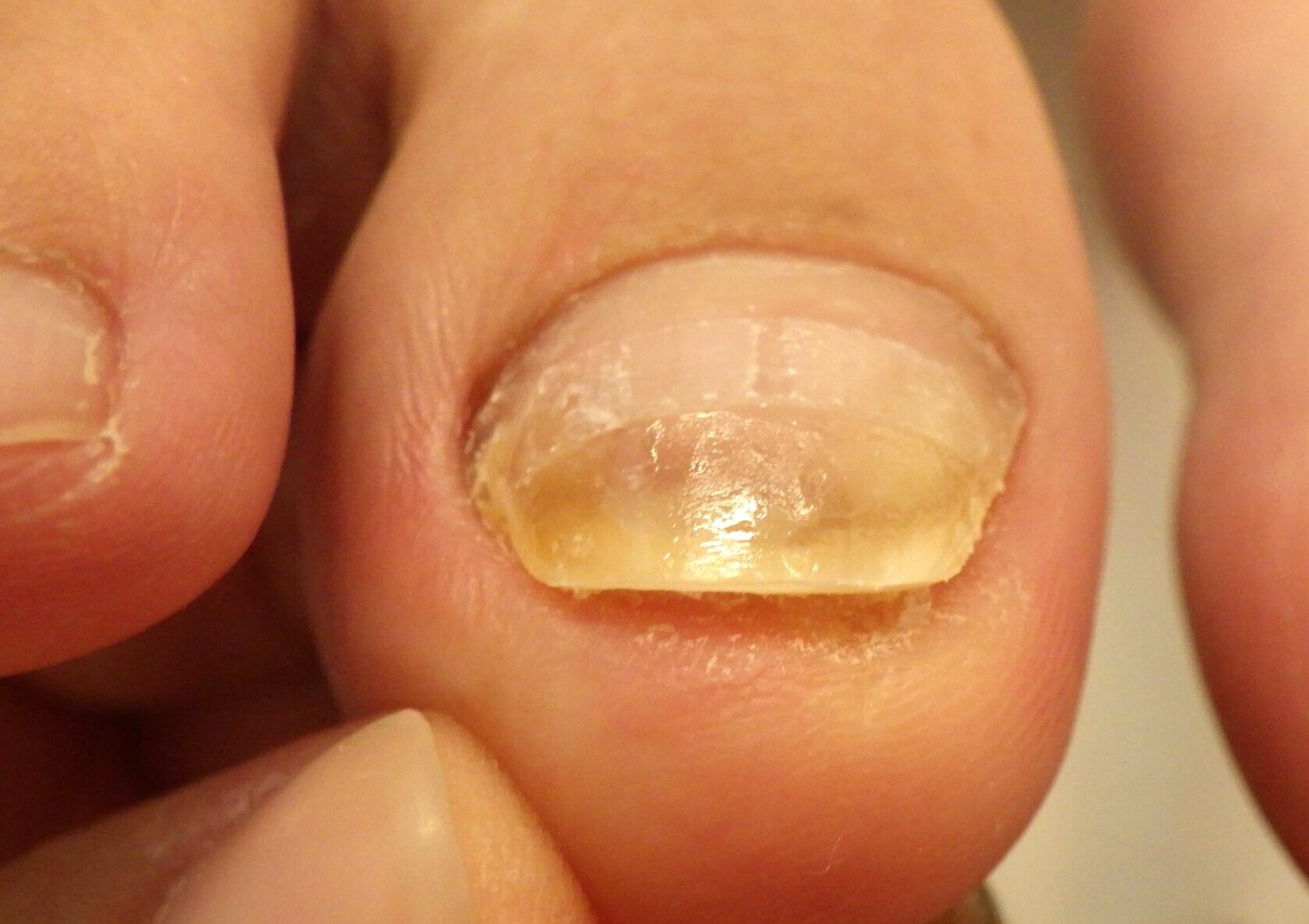 八王子市　巻き爪　アフター