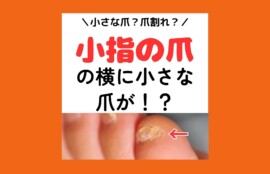 秦野市　巻き爪　副爪