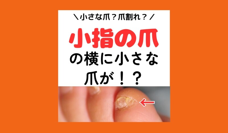 秦野市　巻き爪　副爪