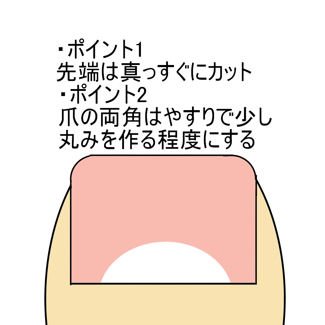 秦野市　巻き爪　スクエアオフ