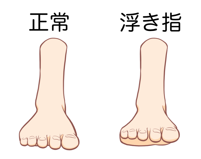 秦野市　巻き爪　浮き指