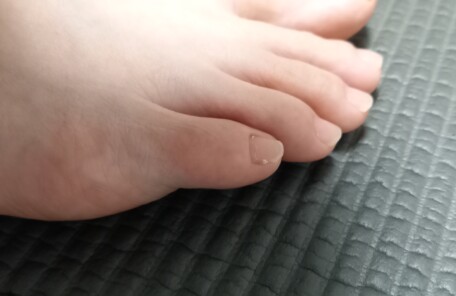 秦野市　巻き爪　足