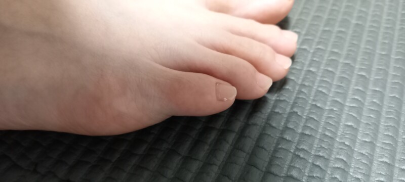 秦野市 巻き爪 足