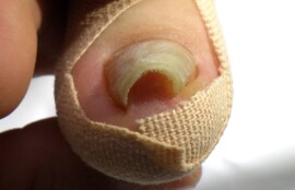 秦野市　巻き爪　ビフォー