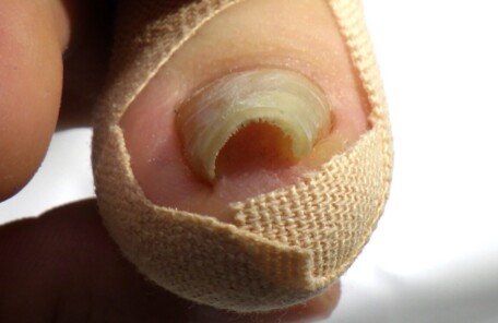 秦野市　巻き爪　ビフォー