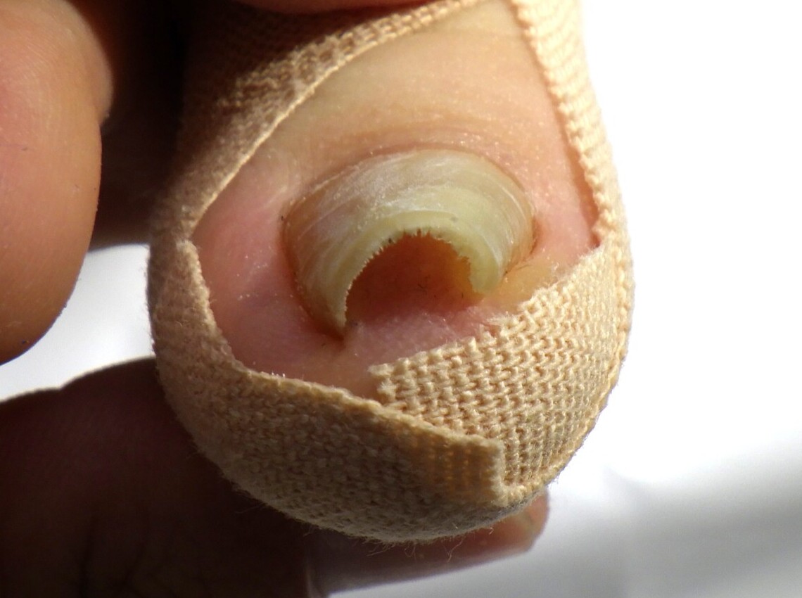 秦野市 巻き爪 ビフォー