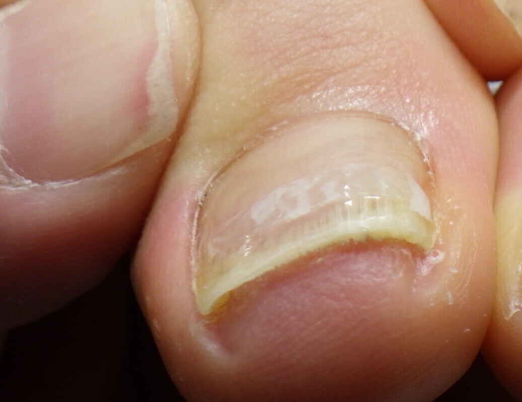 秦野市 巻き爪 アフター