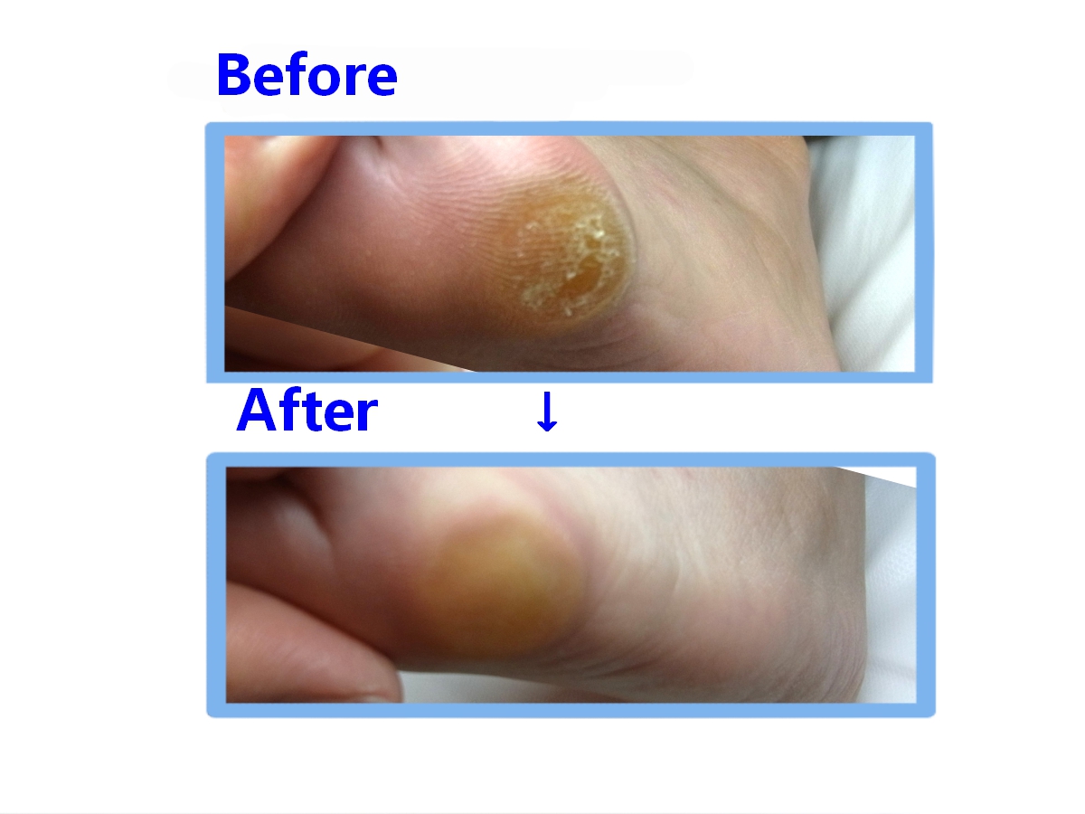 秦野市 巻き爪 胼胝