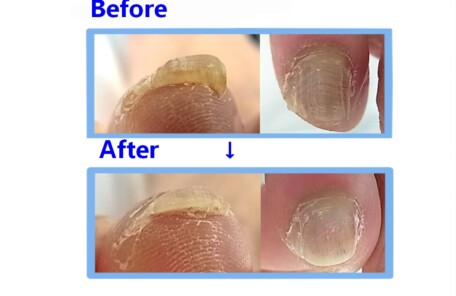 秦野市　巻き爪　肥厚爪