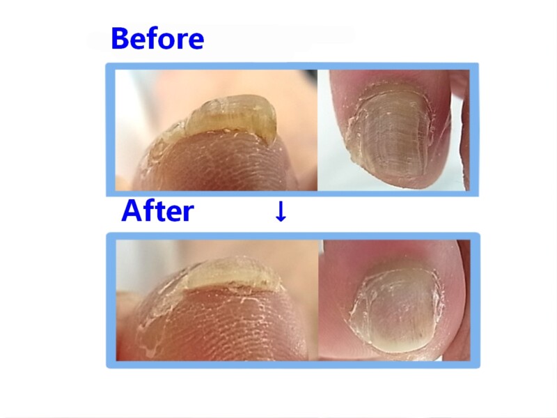 秦野市　巻き爪　肥厚爪