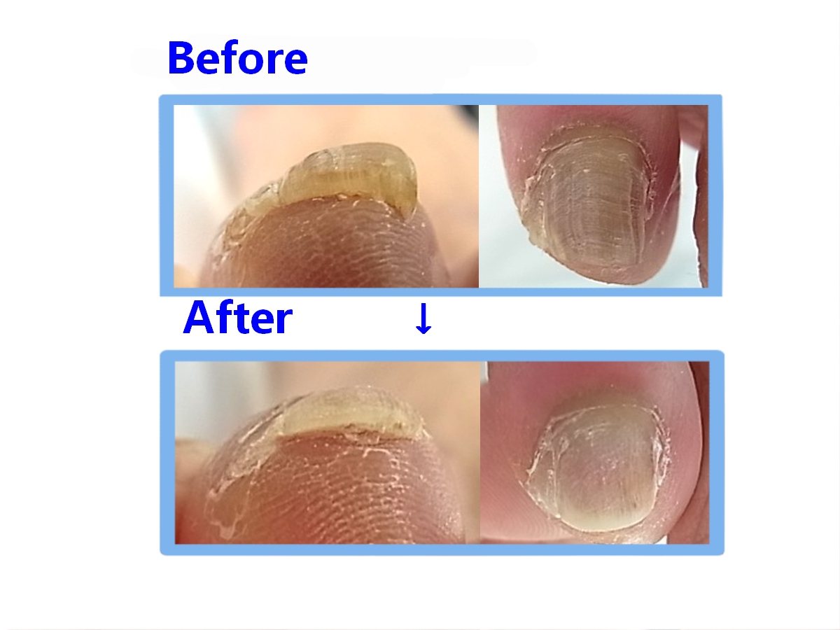 秦野市 巻き爪 肥厚爪
