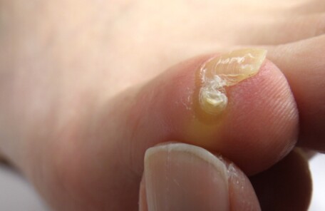 秦野市　巻き爪　ビフォー