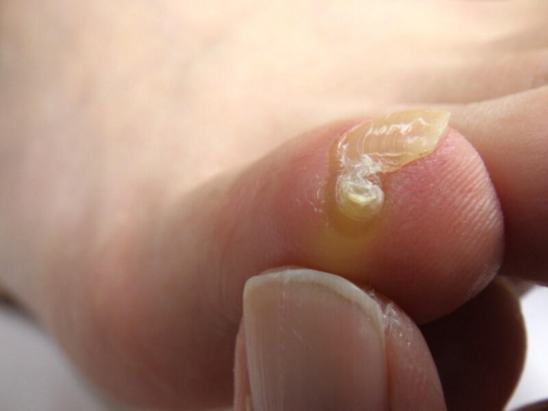 秦野市　巻き爪　ビフォー