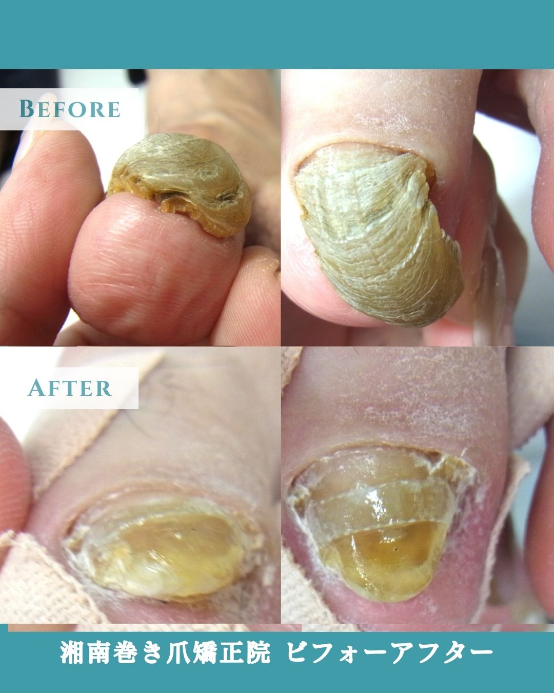 秦野市　巻き爪　変形爪