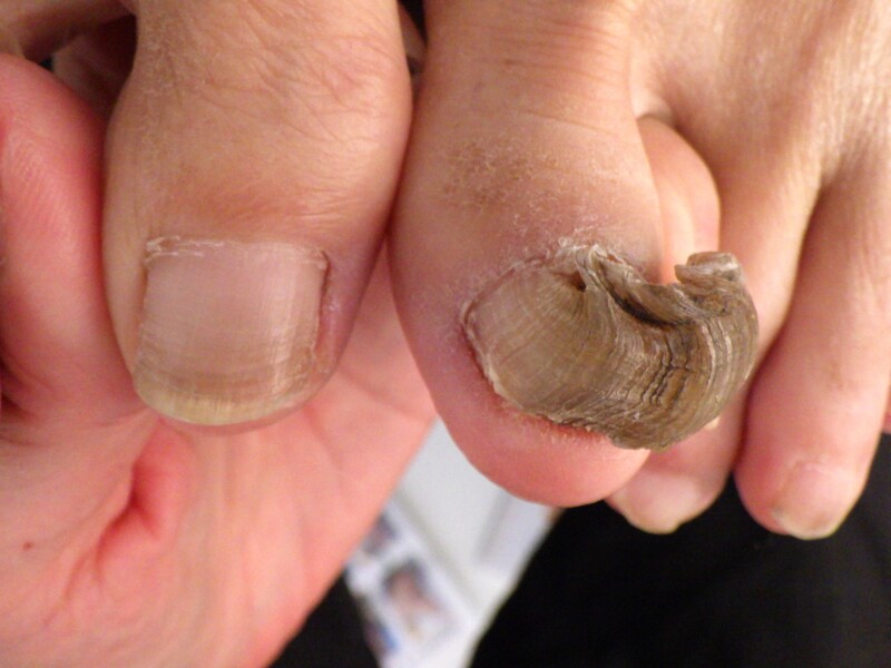 秦野市　巻き爪　変形爪