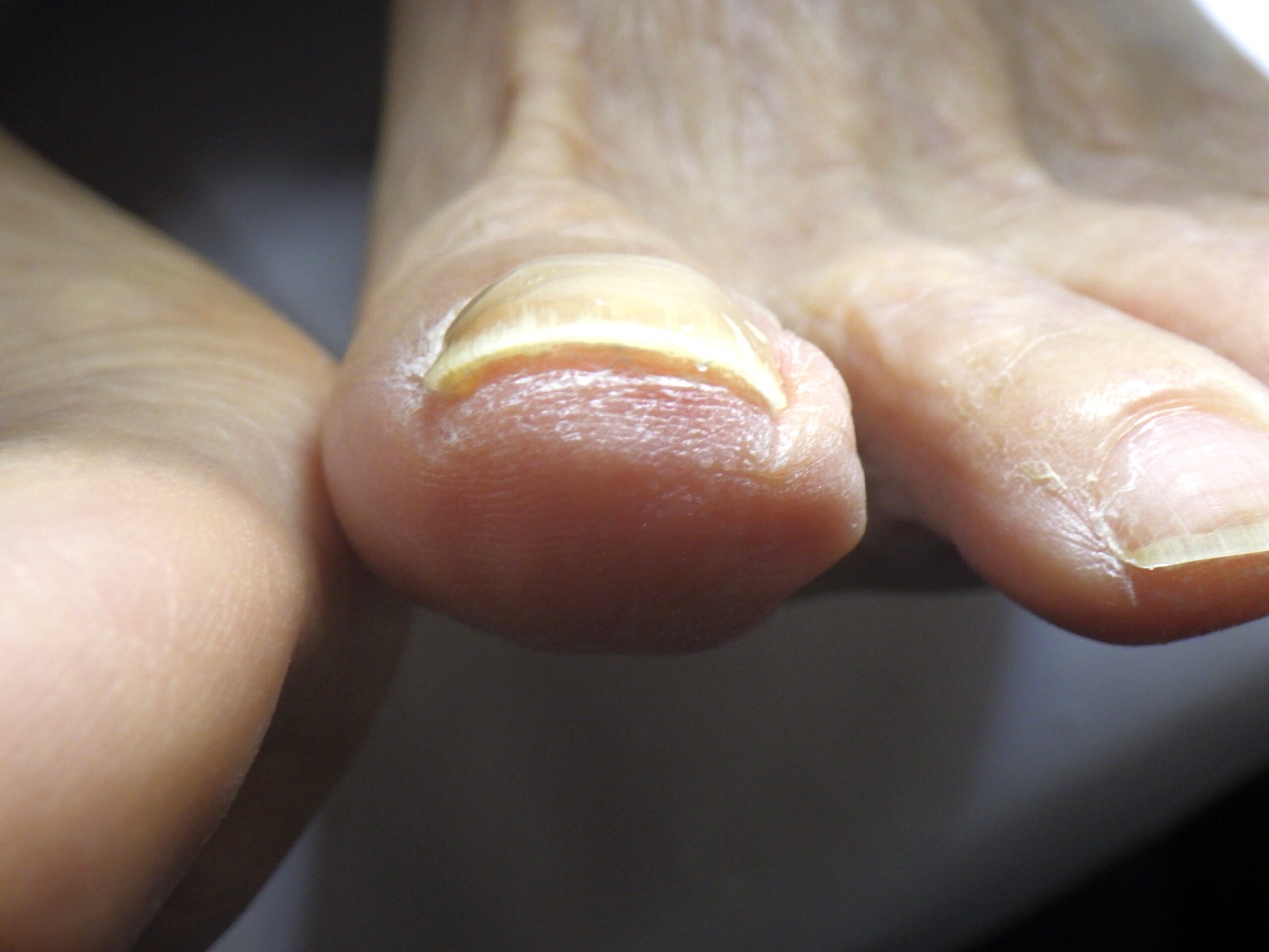 秦野市 巻き爪 アフター