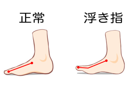 秦野市　巻き爪　浮き指