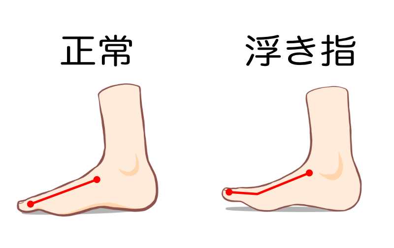 秦野市　巻き爪　浮き指