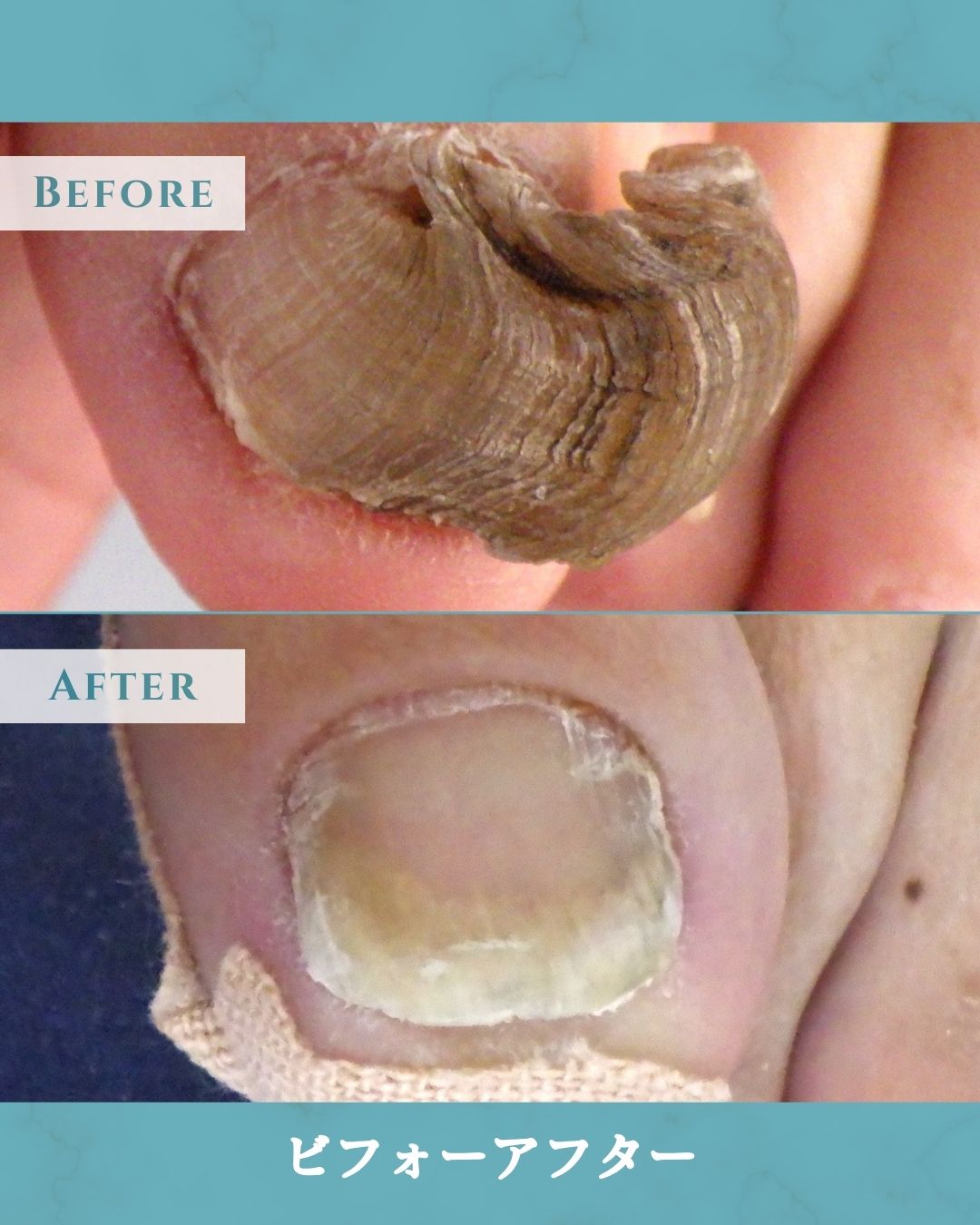 本厚木　巻き爪　変形爪