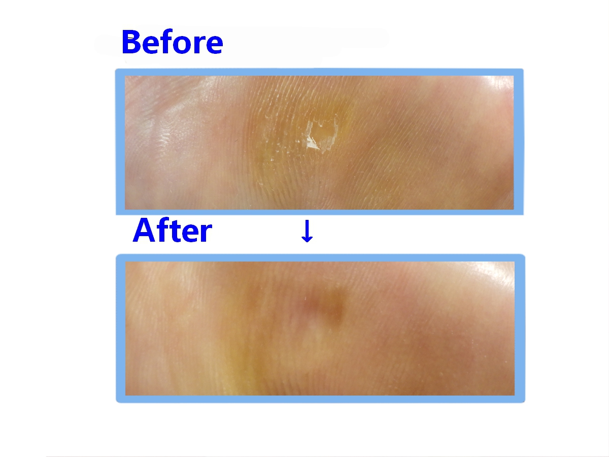 本厚木　巻き爪　足