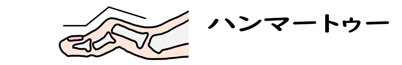 本厚木 巻き爪 ハンマートゥ