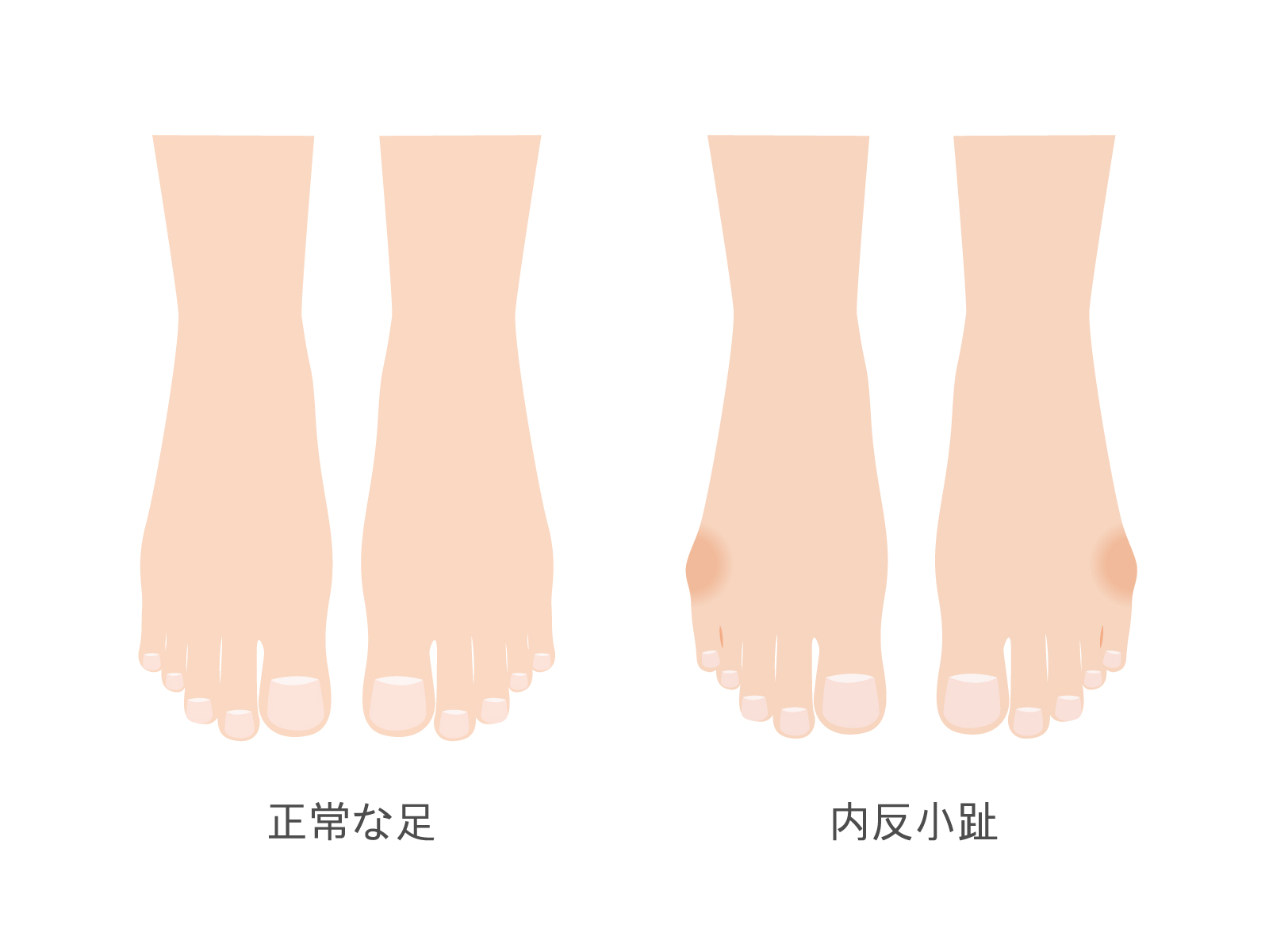 本厚木　巻き爪　内反小趾