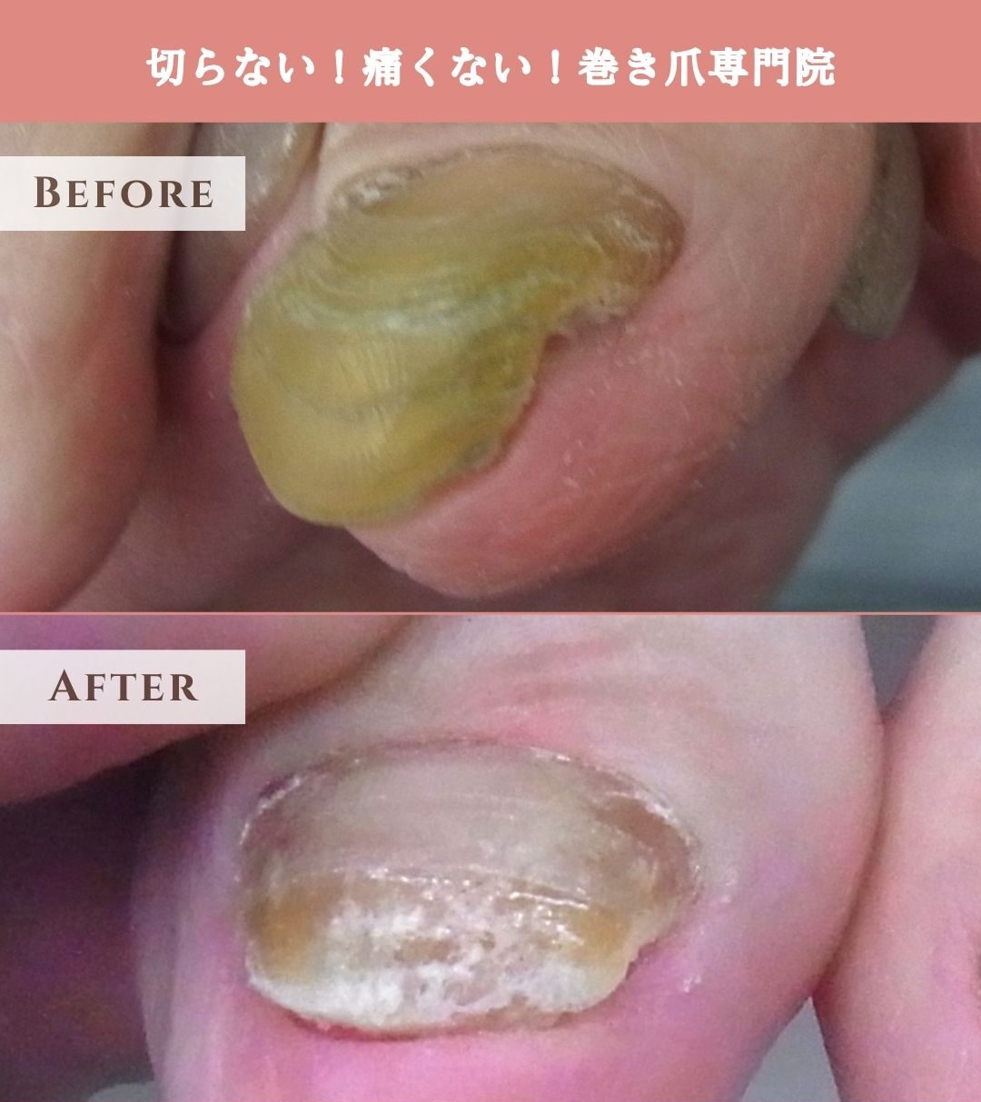 本厚木 巻き爪 変形爪