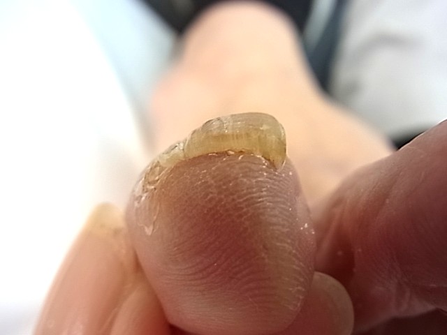 鎌倉市　巻き爪　肥厚爪