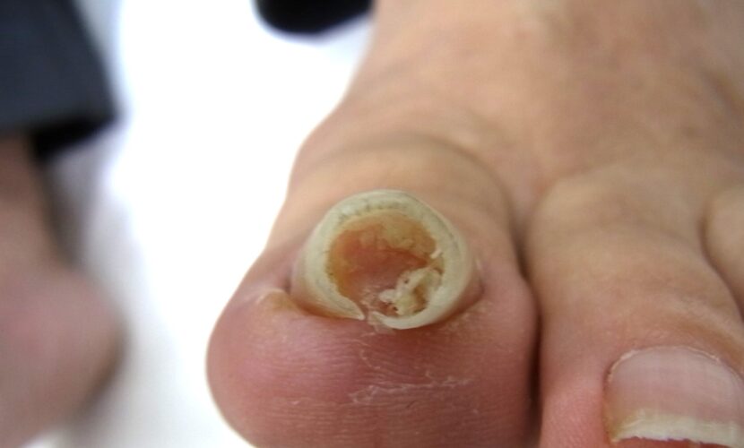 鎌倉市　巻き爪　ビフォー