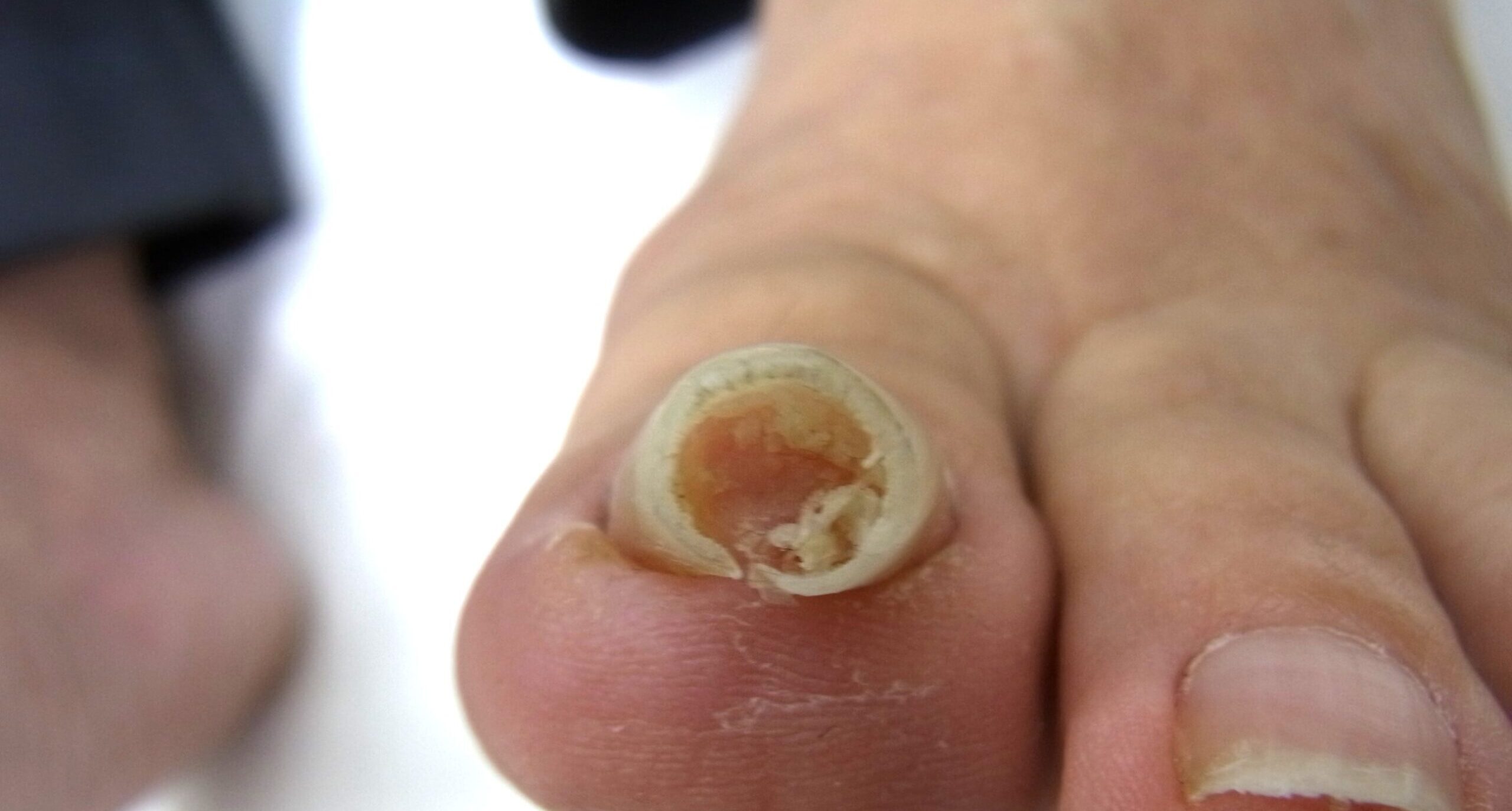  茅ケ崎市　巻き爪　ビフォー