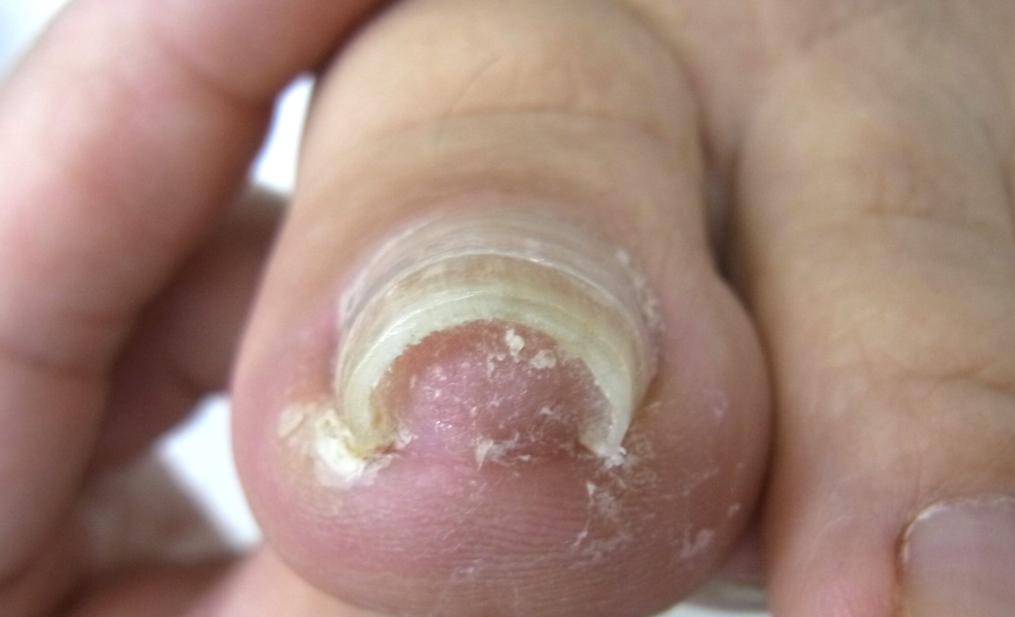 茅ヶ崎市　巻き爪　アフター