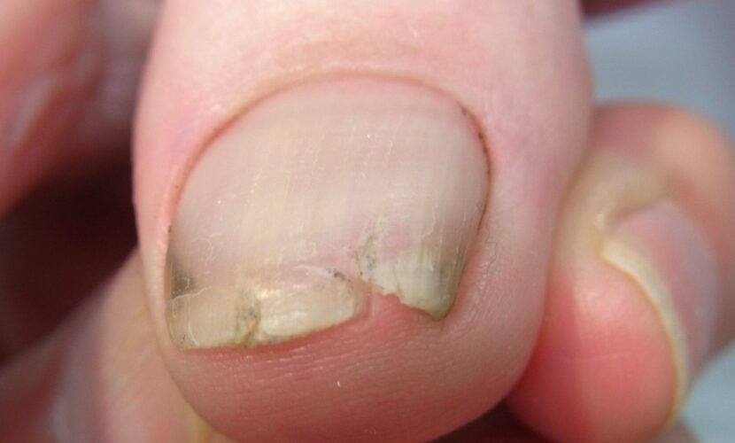 鎌倉市　巻き爪　割れ爪