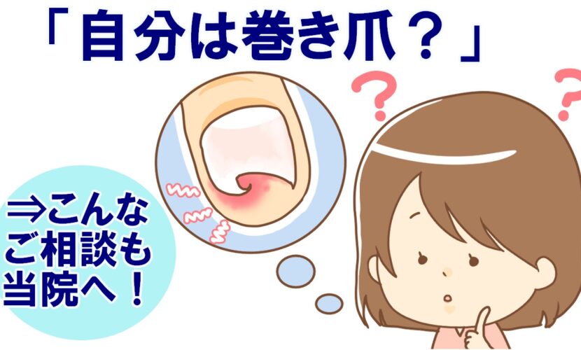 鎌倉市　巻き爪　無料相談会