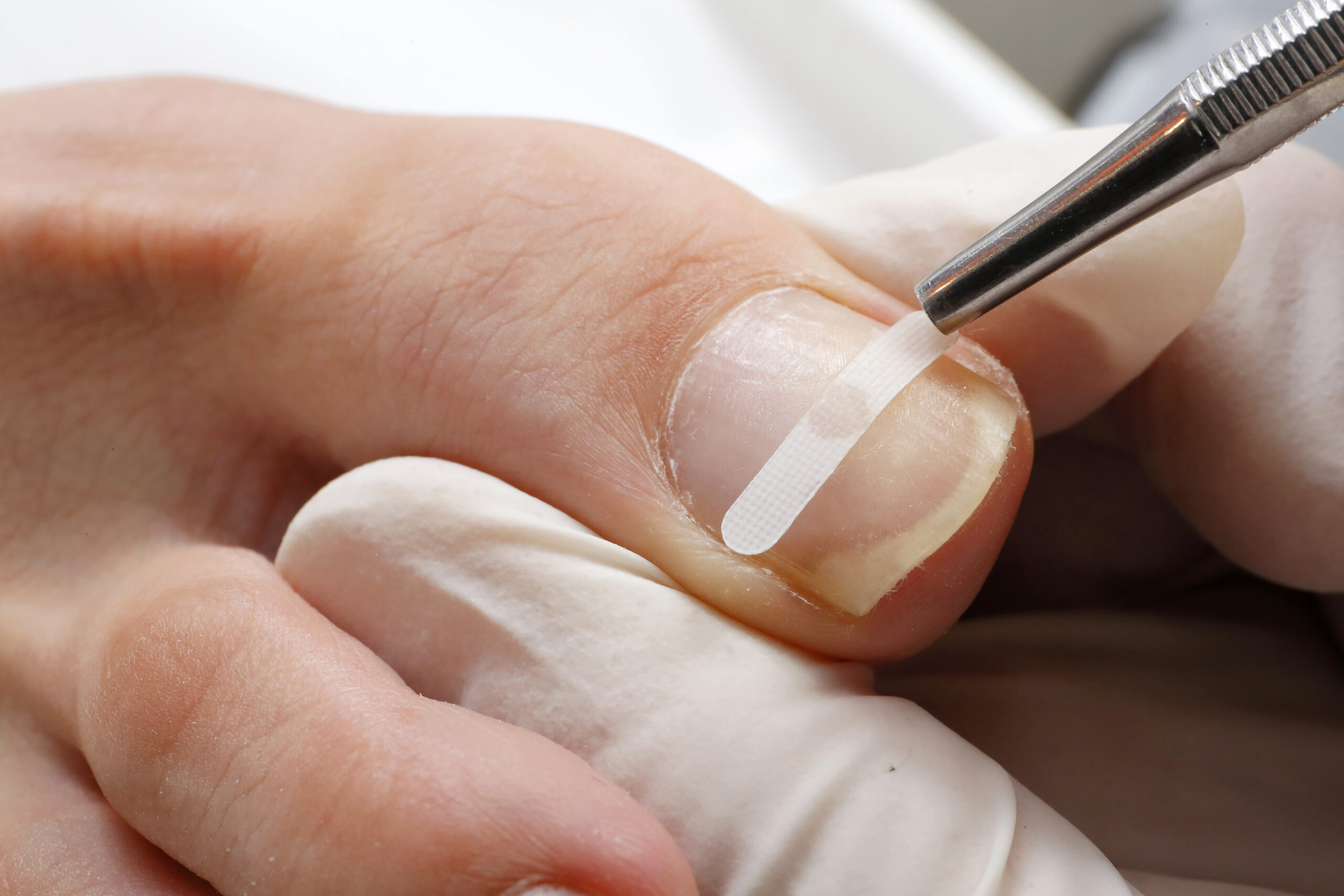 金沢市　巻き爪　プレート