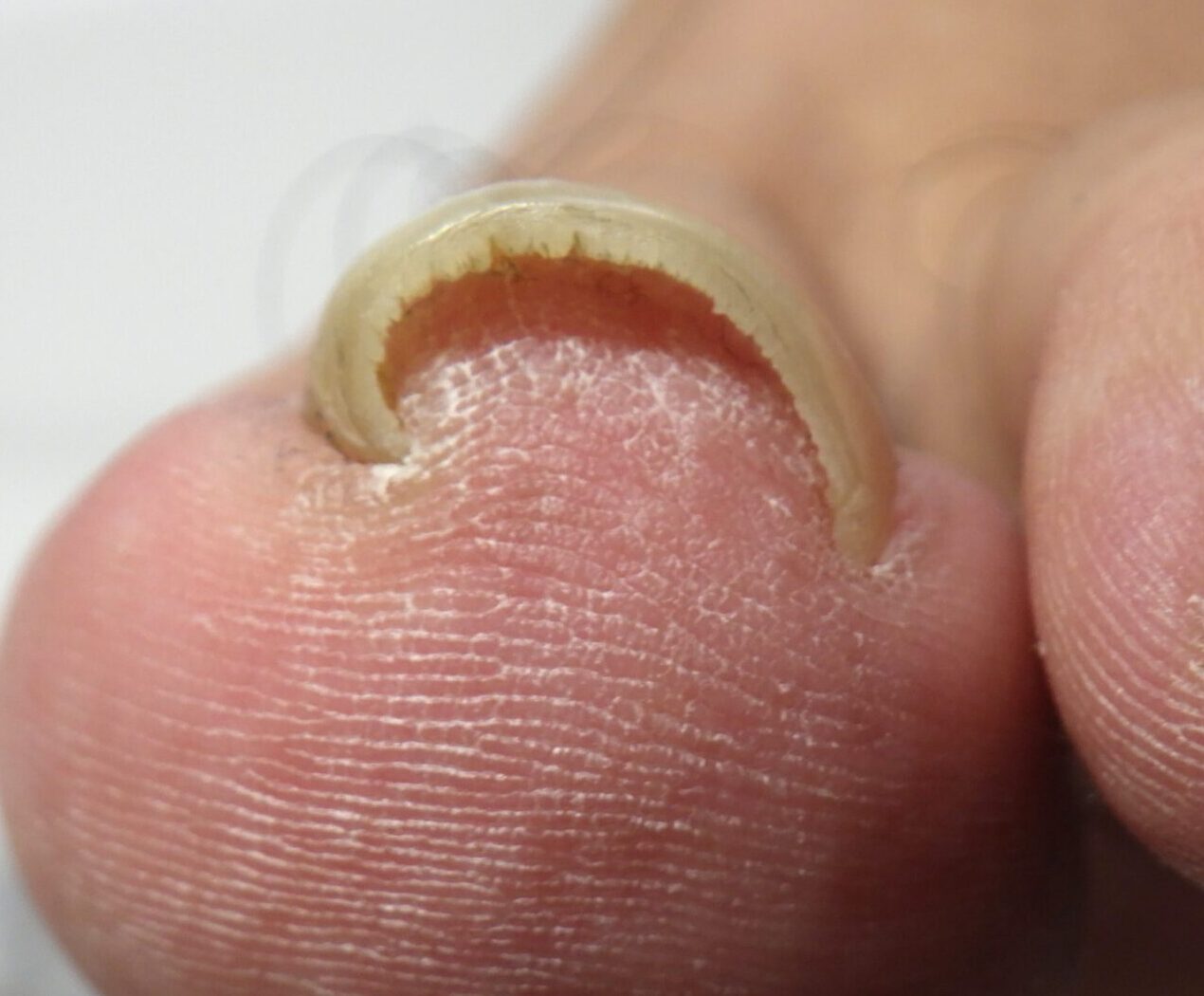  茅ケ崎市　巻き爪　ビフォー