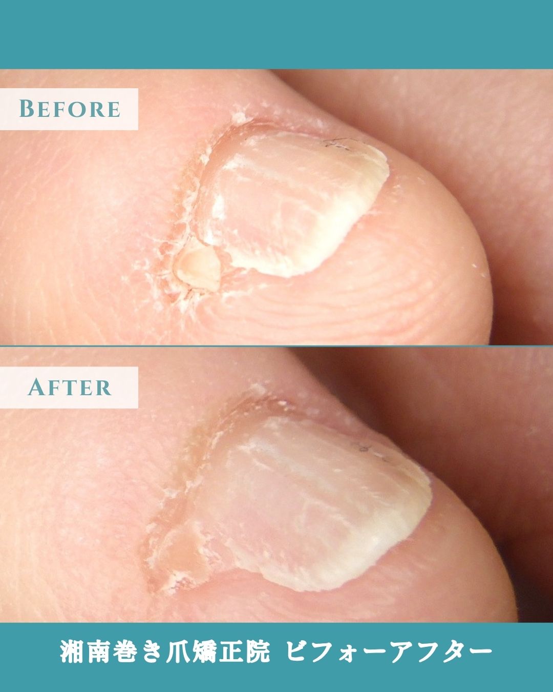 鎌倉市　巻き爪　副爪
