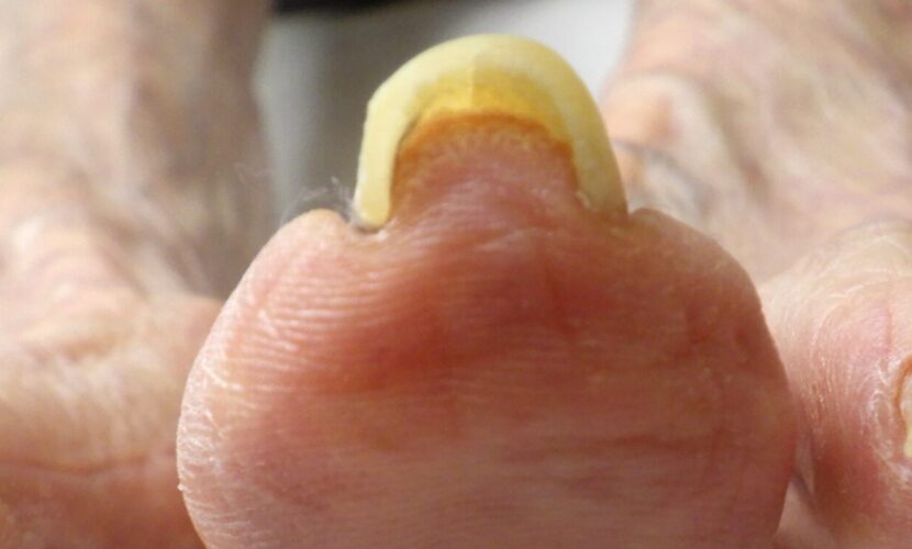 鎌倉市　巻き爪　ビフォー