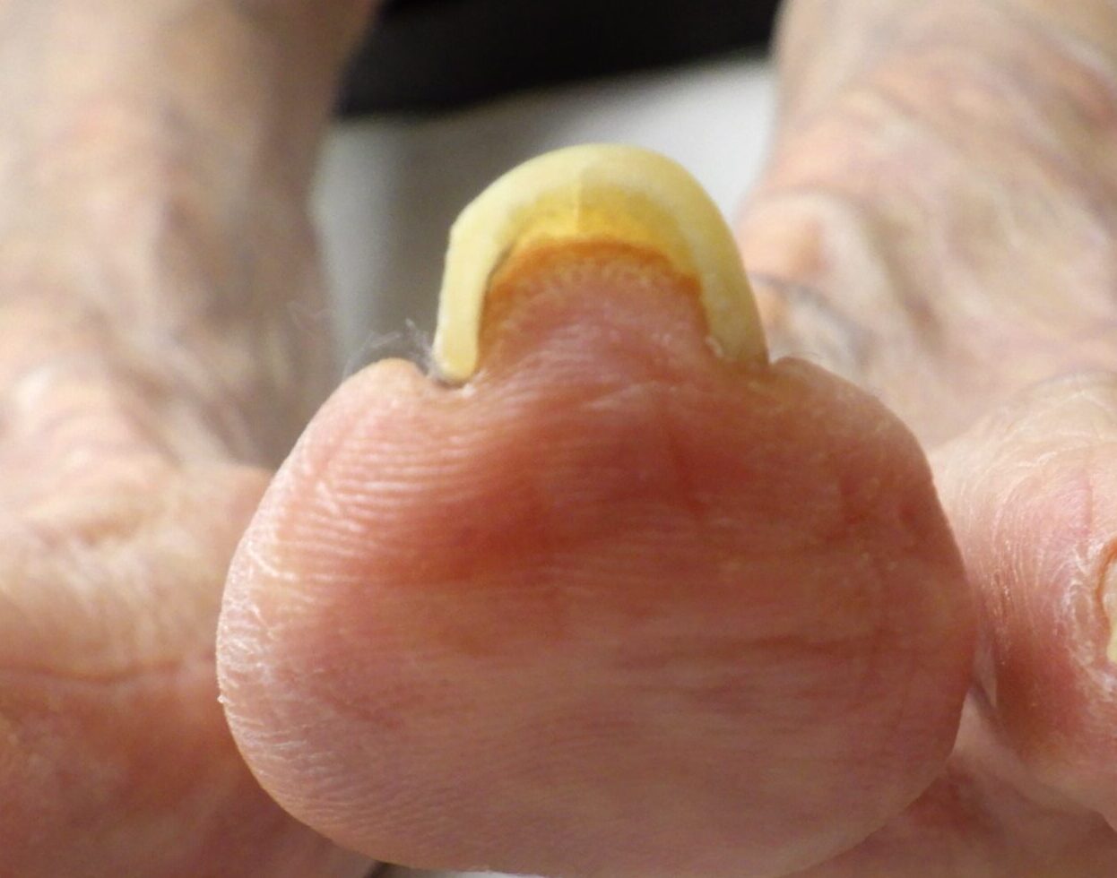  茅ケ崎市　巻き爪　ビフォー