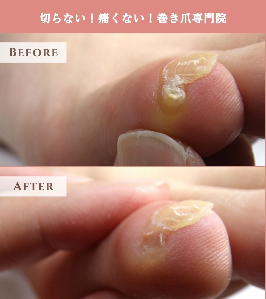 鎌倉市　巻き爪　副爪