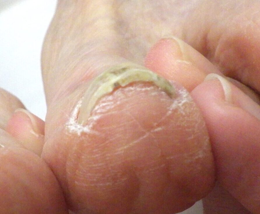 茅ヶ崎市　巻き爪　アフター